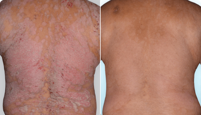 Psoriasis Skin Comfort